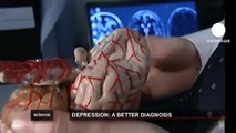 euronews science - La depresión modifica la estructura cerebral