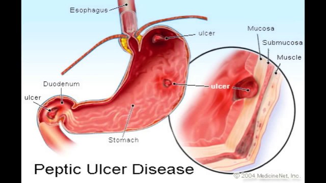 Peptic Ulcer Disease and H. Pylori