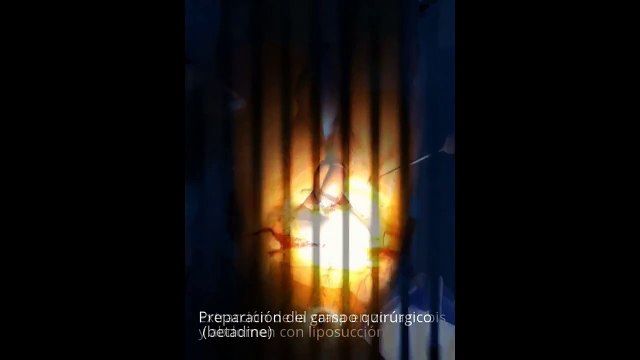 Alargamiento y engrosamiento de pene (Dr Jose María Jiménez)