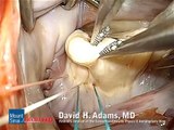 Mitral Valve Repair featuring the first U.S. Implant of the Physio II Annuloplasty Ring