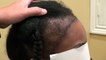 Black Woman Hairline Bald Hair Loss Transplant Restoration Surgery Northern California Dr. Diep www.mhtaclinic.com