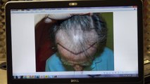 Excellent Man Hair Loss Transplant Surgery Result 1 Year Before After Photos Dr. Diep www.mhtaclinic.com