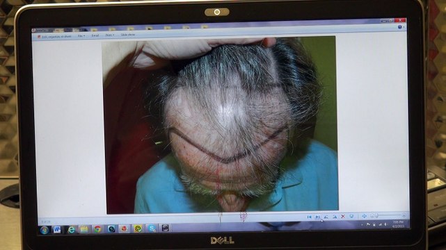 Excellent Man Hair Loss Transplant Surgery Result 1 Year Before After Photos Dr. Diep mhtaclinic.com