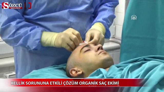 Kellik sorununa etkili çözüm organik saç ekimi