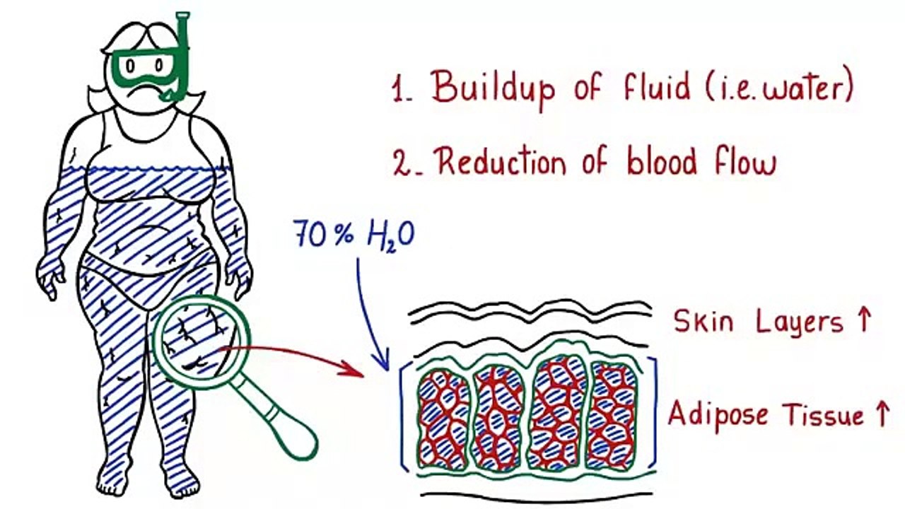 Cellulite Factor  Free presentation reveals an unusual secret to reducing the apearence of cellulite