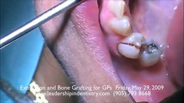 Extraction of Fractured Tooth Simplified (Continuous Video)
