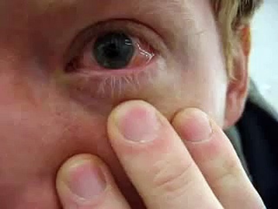 Pingueculitis or Episcleritis?