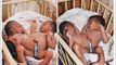 Siamese Twins With Four Hands, 3 Legs And Two Heads Born In Benue State