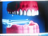 Implante Dental De Titanio