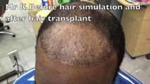 Interview Mr K.- hair simulation for hair transplant scar cover- scalp tattoo | SMP