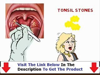 Banish Tonsil Stones Get  Bonus + Discount