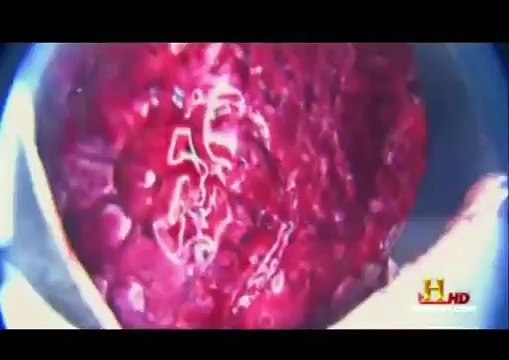 (MUST SEE) NANO micro chips Proofs of Mind Control MK ULTRA RFiD implants