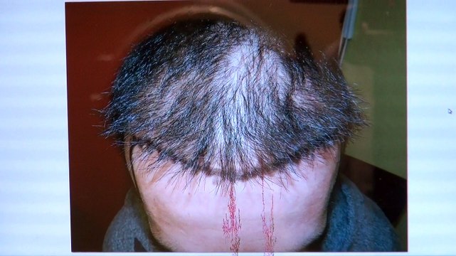 Fantastic Receding Hairline Bald Man Hair Loss Transplant 1 Yr Result Before After Photos Dr. Diep mhtaclinic.com