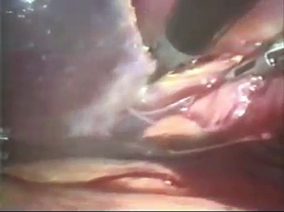 Laparoscopic Splenectomy