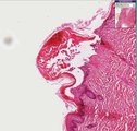 Histopathology Skin--Varicella (chicken pox)