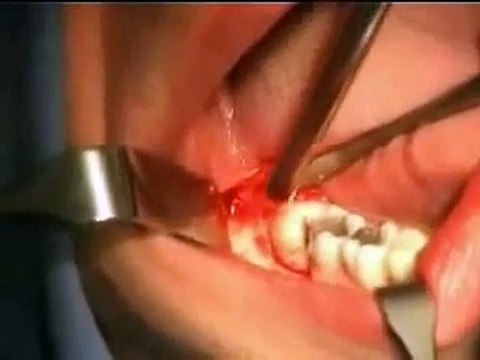 Dente giudizio incluso - intervento chirurgico