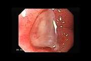 Endoscopy of a Duodenal Ulcer