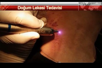 Doğum Lekesi Tedavisi Ankara