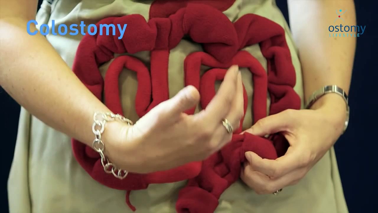 A quick explanation: colostomy, ileostomy, urostomy by Ostomy Lifestyle