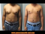 Dr. Blau / Gynecomastia Adolescent  / Male Breast Reduction Teens