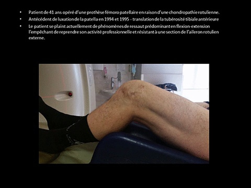 Ressaut sur prothèse fémoro patellaire