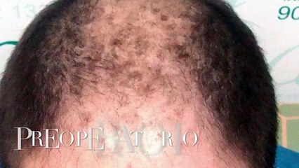 CLINICAS CETA CAPITAL www.injertodepelo.es