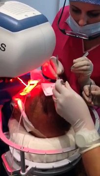 Présentation d'un opération de prélèvement d'implant capillaire