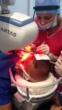 Présentation de la greffe d'implants capillaire à l'aide du robot ARTAS