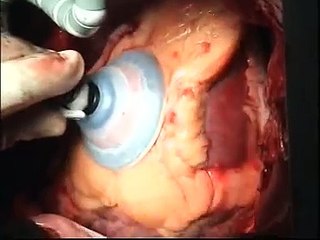 Positioning the Heart before  OPCAB (normal beating  heart surgery)