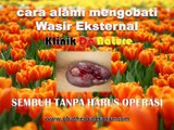 cara alami mengobati wasir eksternal