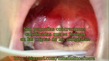 Remedios para calculos amigdalinos