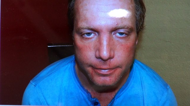 Fantastic Receding Hairline Bald Hair Loss Treatment Dr. Diep mhtaclinic.com 1 Yr Result Before After Photos