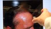 Hairline Lowering Hair Transplant Restoration Treatment Surgery 12 Months Follow Up Result Dr. Diep www.mhtaclinic.com