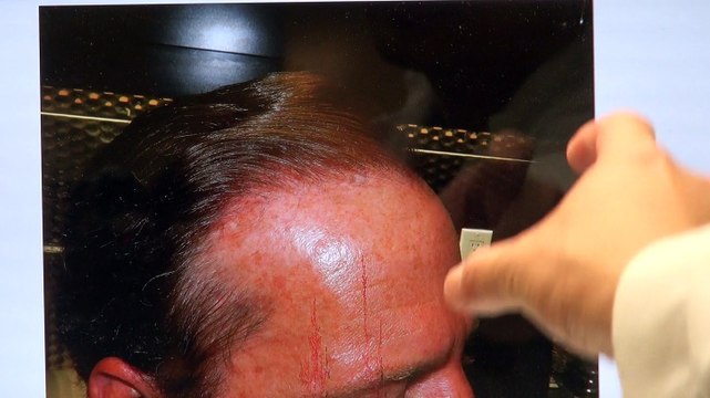 Hairline Lowering Hair Transplant Restoration Treatment Surgery 12 Months Follow Up Result Dr. Diep mhtaclinic.com