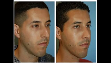 Ethnic Rhinoplasty Middle Eastern Versus Hispanic Nose