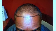 Black Man Dense Hairline Hair Loss Transplant Restoration Surgery Dr. Diep 1 Yr Follow Up Result www.mhtaclinic.com
