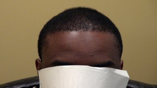 Fantastic Black Man Hair Restoration Treatment 1 Yr Result Dr. Diep www.mhtaclinic.com Before After Photos