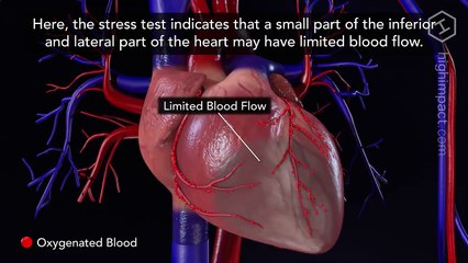 Cardiac Catheterization and Stenting