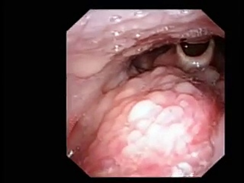 Sinus infection │ Seeing inside the nose │ Endoscopy of the nose in sinus infection
