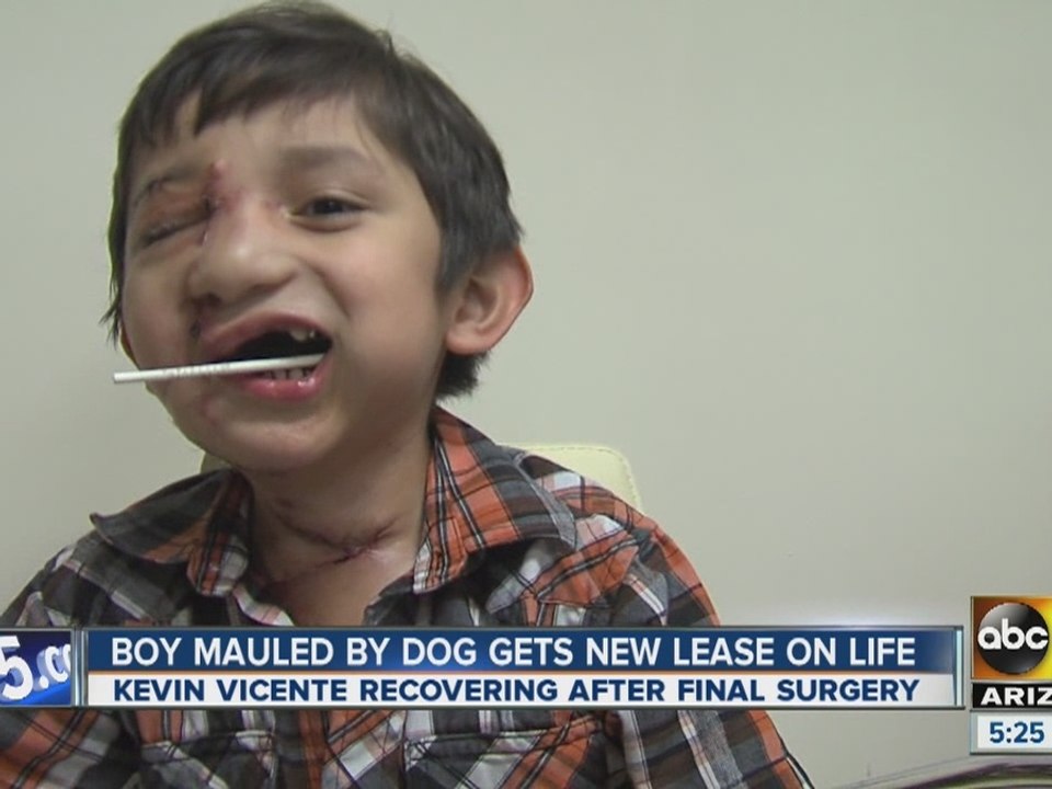 Valley boy mauled by pitbull gets new lease on life