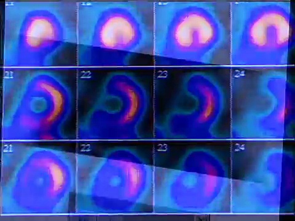 Nuclear Cardiac Imaging - Nuclear Medicine