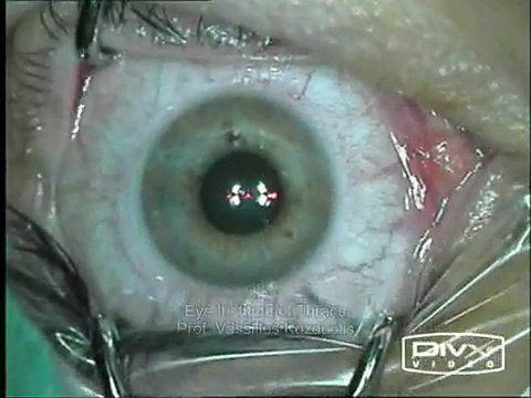 Refractive Surgery (LASIK)