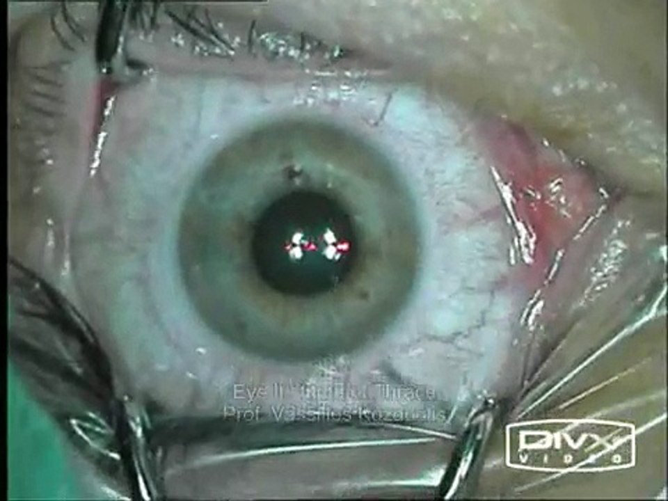 Refractive Surgery (LASIK)