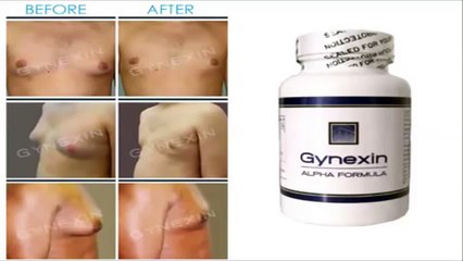 Gynexin Reviews - Best Gynecomastia Treatment Without Surgery
