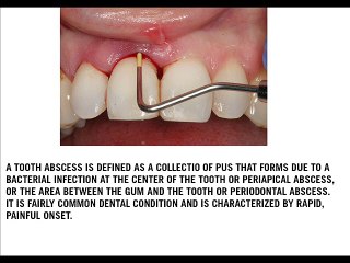 Tooth Abscess Home Remedies