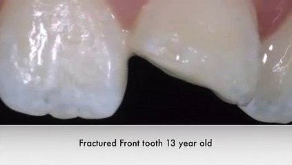 White Filling Restoration Front Tooth