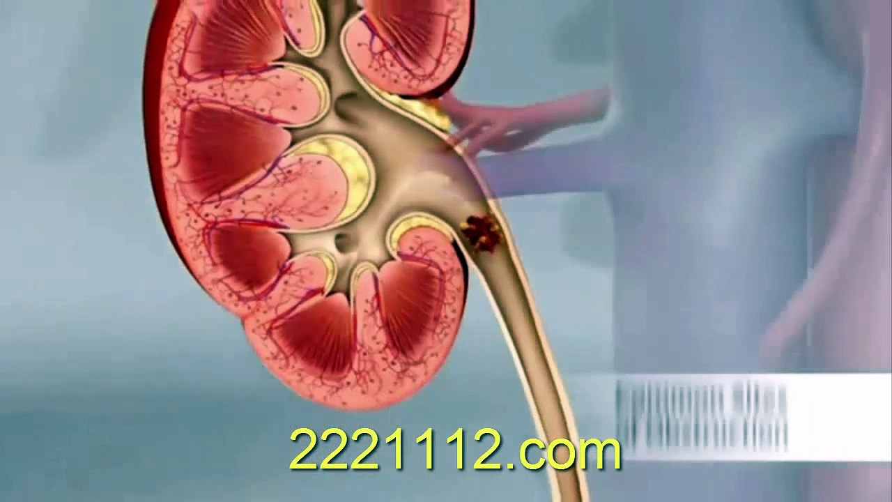 How Do Kidney Stones