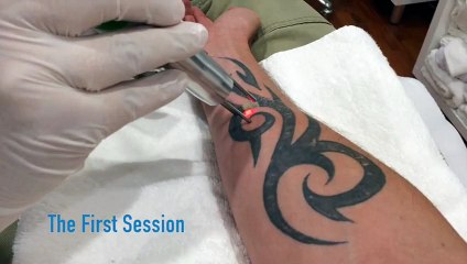 Removing a Tribal Tattoo: Part 3