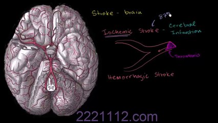 Strokes