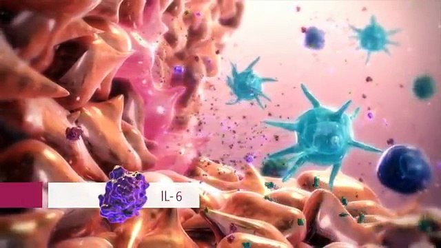 Rheumatoid arthritis - hybrid medical animations